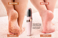 SmoothStep Callus Remover